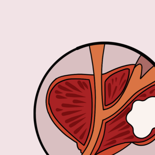 Bladder Cancer: Understanding the Risks, the Signs, and the Strategy