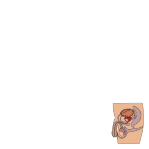 Understanding Prostatitis: A Guide to Inflammation, Infection, and Precision Management